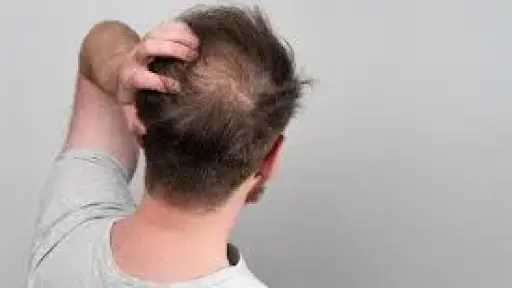 اكتشاف علاج طبيعي للصلع الوراثي...